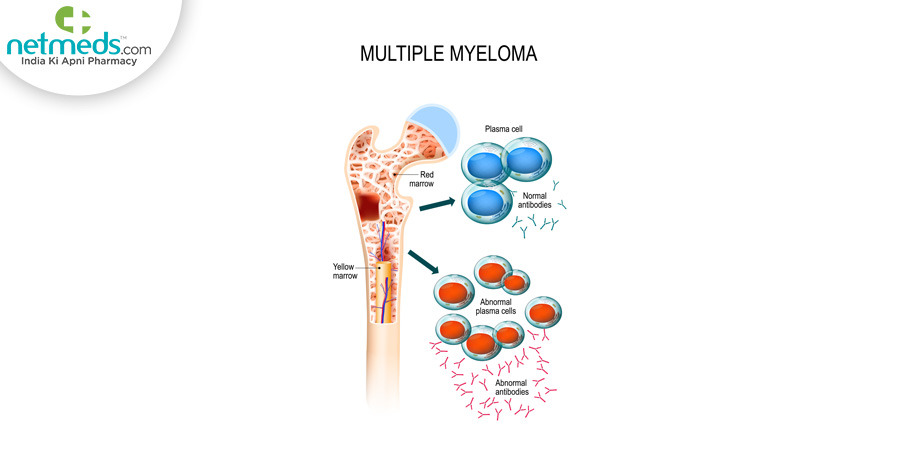 Multiple myeloma bone cancer