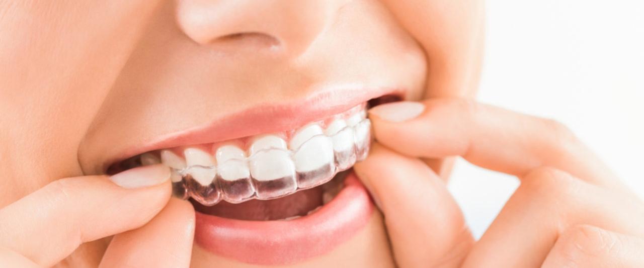 How long does invisalign take to work