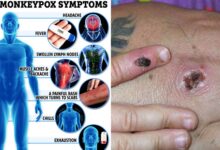 Monkeypox treatment options what to know right now