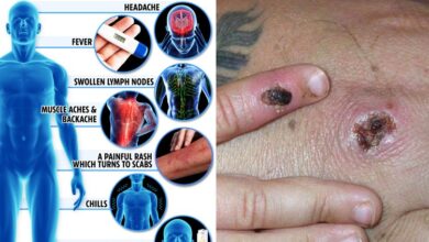 Monkeypox treatment options what to know right now