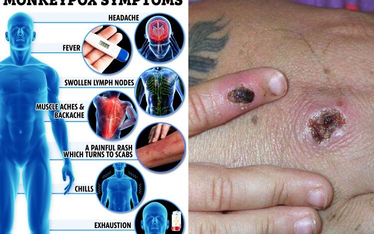 Monkeypox treatment options what to know right now