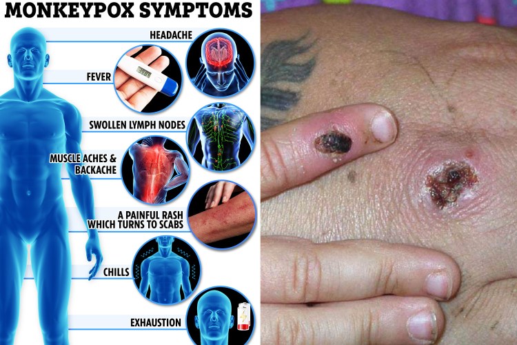 Monkeypox treatment options what to know right now