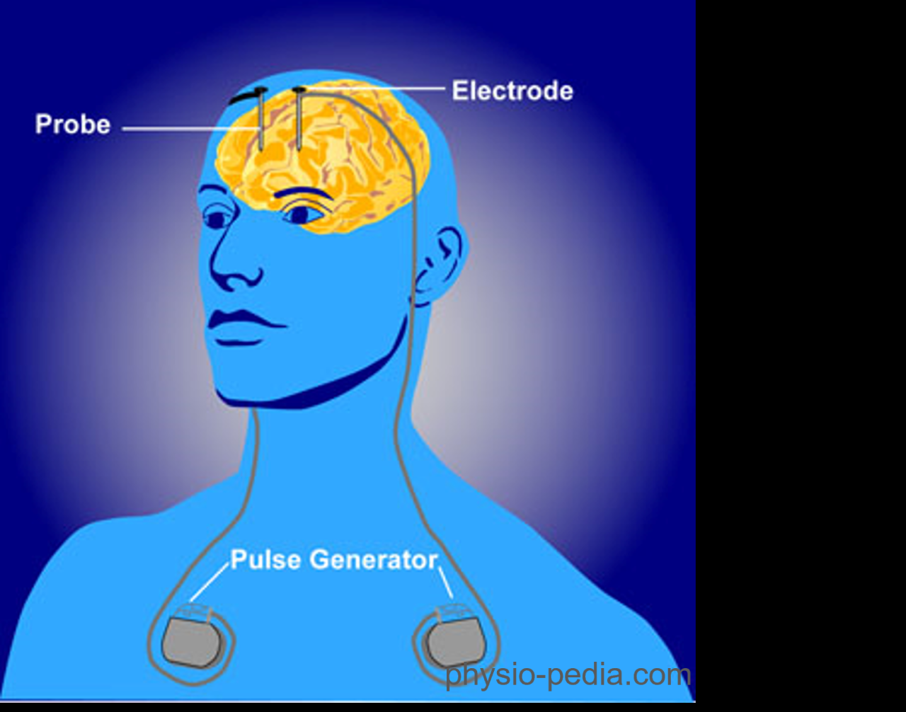 Deep brain stimulation dbs