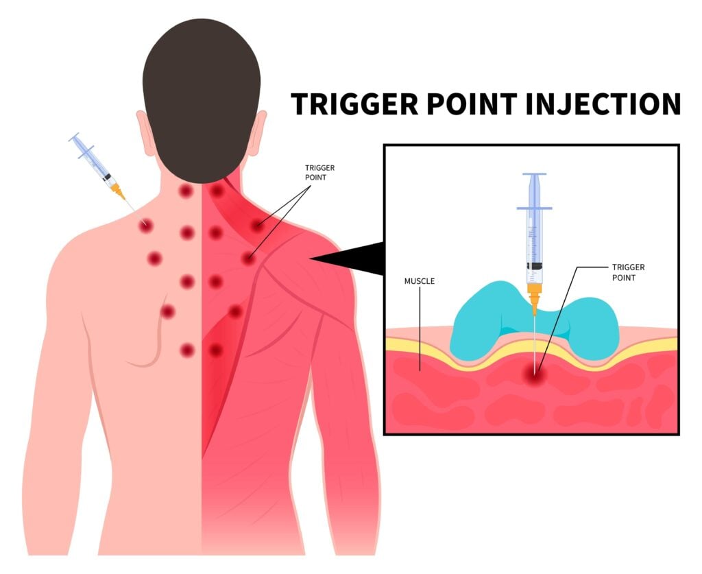 Trigger point injections for migraines