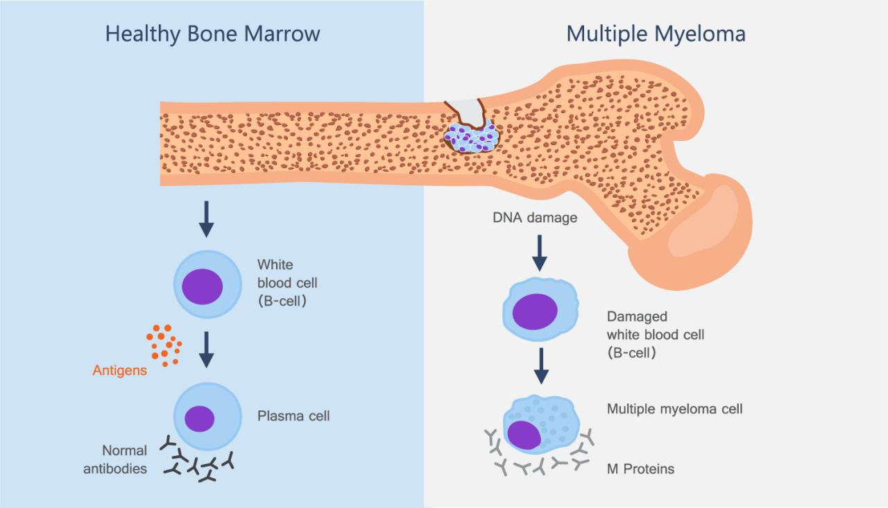 Multiple myeloma bone cancer