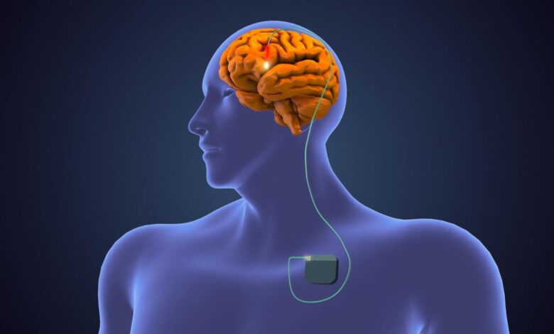 Deep brain stimulation dbs
