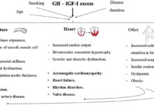 Acromegaly slide patients