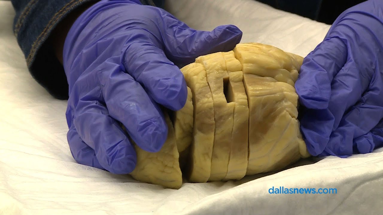Program for transplant patients hold old hearts in hands