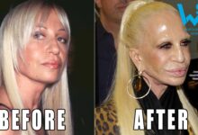 Dangerous plastic surgery procedures