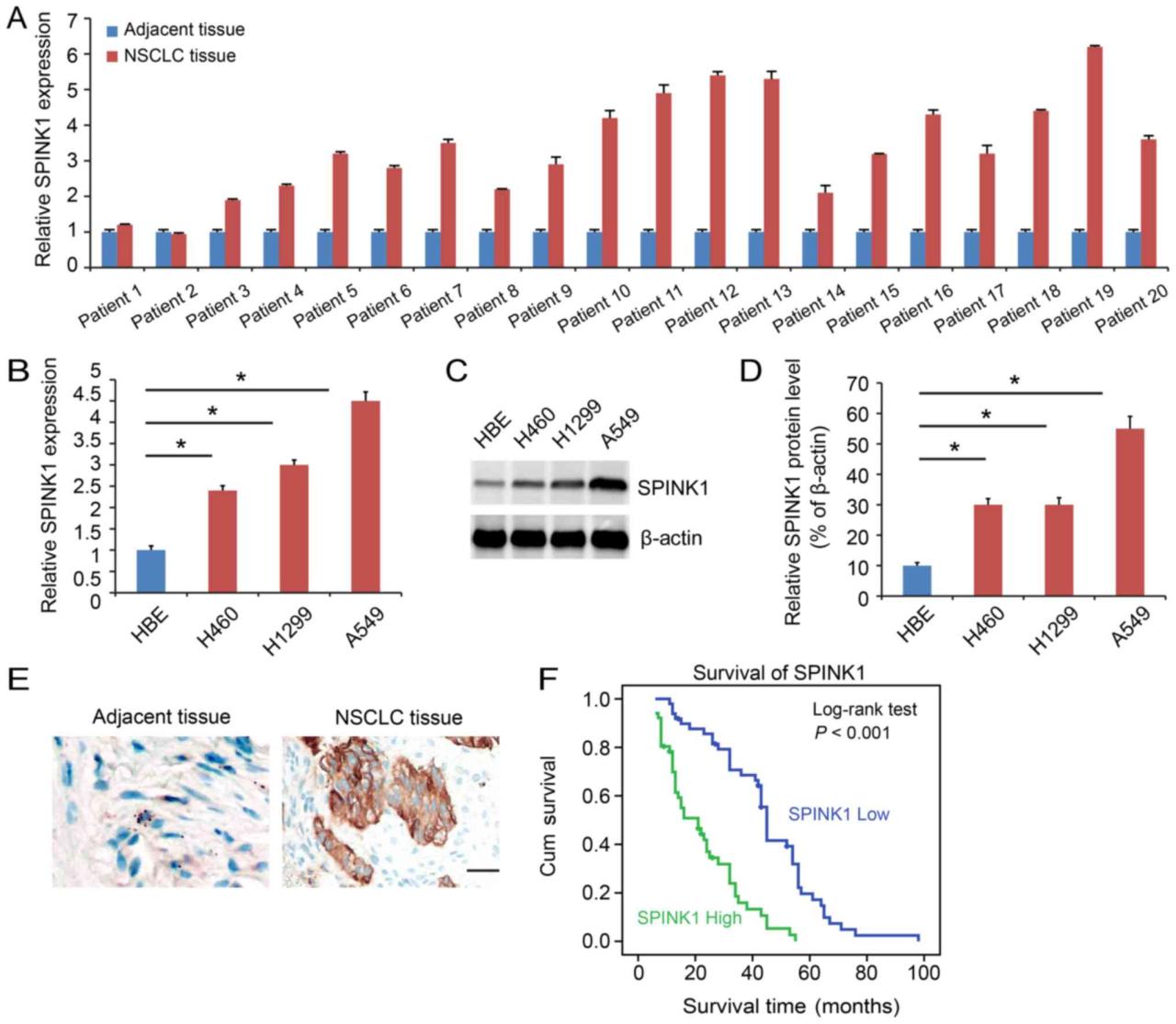 Prostate cancer gene spink1