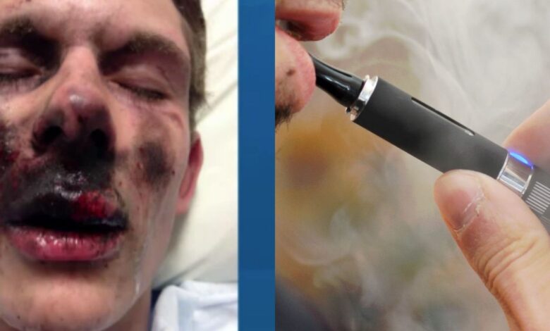 Concern growing over e cigarette explosions