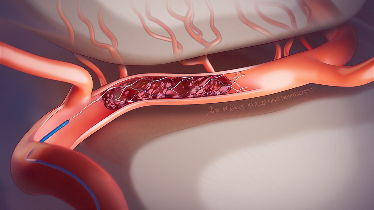 Are brain aneurysms hereditary