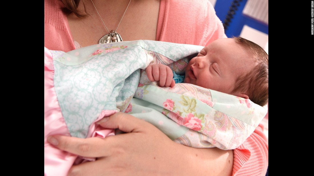Baby twice born cnn Will born twice surgery become common