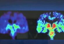 Brain cancer vaccine clinical trial