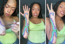 Woman decides to stop covering vitiligo joins awareness effort