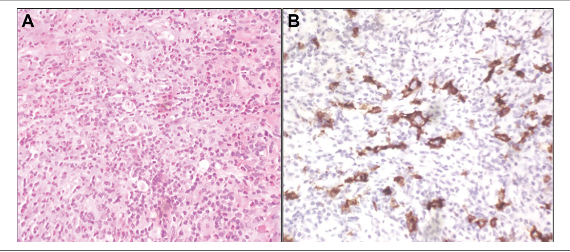 Hodgkins lymphoma dental implications