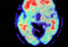 Can alzheimers be detected 30 years before it appears