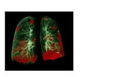 Long covid can cause heart problems along with breathing difficulties