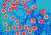Herpes virus sores