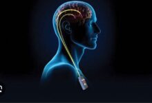 This man with parkinsons experienced improvement after trying deep brain stimulation