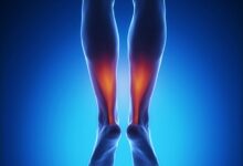 Achilles tendon rupture symptoms causes gap treatment credit if located boneandspine