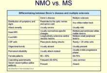 Who treats nmo finding specialist