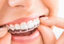 How long does invisalign take to work