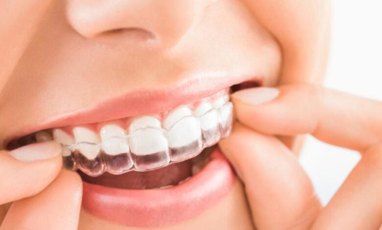How long does invisalign take to work