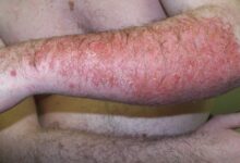 Whats the difference between atopic and contact dermatitis