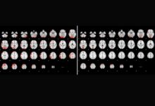 Autism children brain imaging