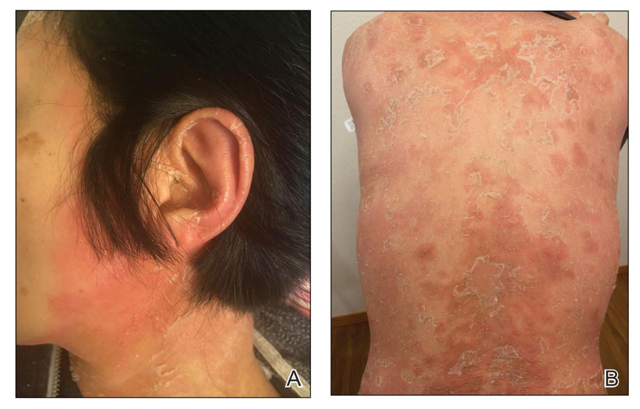 Generalized pustular psoriasis images