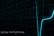 Arrhythmia electrical activity circular pattern