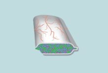 Viacyte diabetes functional cure