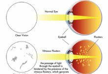 Can dry eyes cause floaters