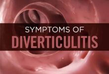 Diverticulitis becoming more common
