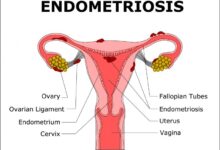 What are the first signs of endometriosis