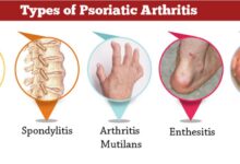 Psoriasis medication otezla leads to fat loss in people with psoriatic arthritis study says