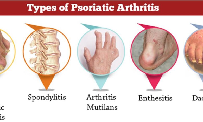 Psoriasis medication otezla leads to fat loss in people with psoriatic arthritis study says