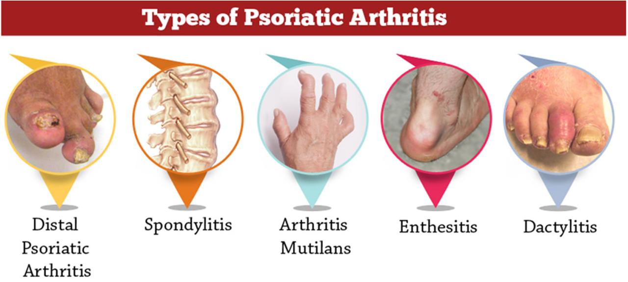 Psoriasis otezla Psoriasis medication otezla leads to fat loss in people with psoriatic arthritis study says