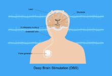 Brain surgery stops parkinsons disease tremors