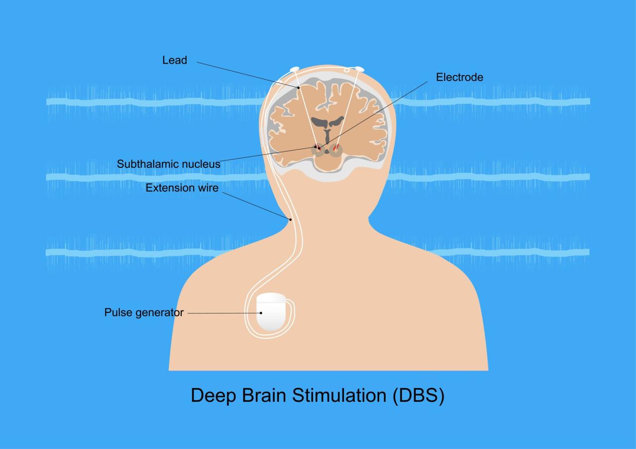 Brain surgery stops parkinsons disease tremors