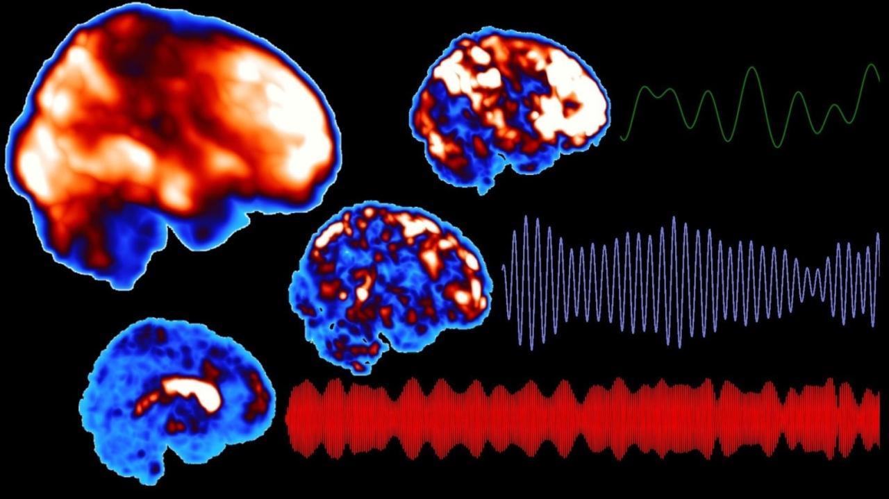Narcolepsy and your brain