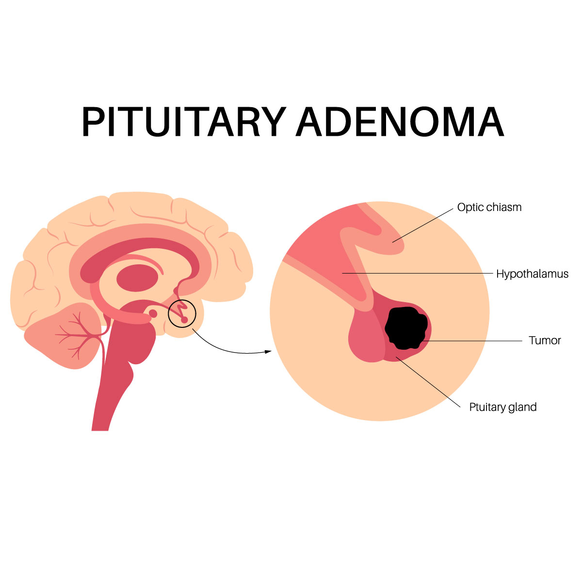 Are pituitary tumors hereditary