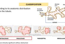 Primary and secondary emphysema
