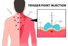 Trigger point injections for migraines