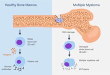 Multiple myeloma bone cancer