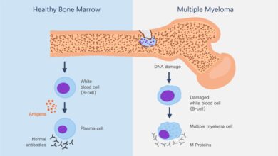 Multiple myeloma bone cancer