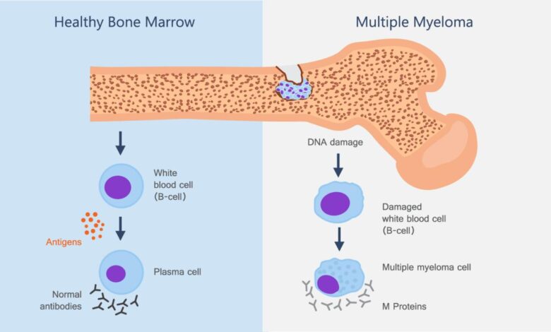 Multiple myeloma bone cancer