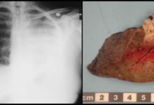 Pulmonary aspergillosis allergic bronchopulmonary type