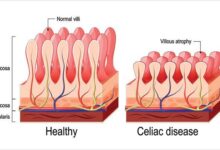 Low gluten wheat for celiac disease